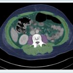 Example of AI-derived, automated body segmentation at the level of lumbar vertebra 3. Segmented tissues are coded with different colors: psoas muscle = purple, skeletal muscle (except psoas muscle) = green, visceral fat = dark green, blue = subcutaneous fat
