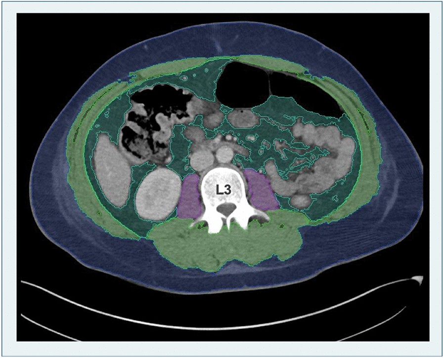 Example of AI-derived, automated body segmentation at the level of lumbar vertebra 3. Segmented tissues are coded with different colors: psoas muscle = purple, skeletal muscle (except psoas muscle) = green, visceral fat = dark green, blue = subcutaneous fat